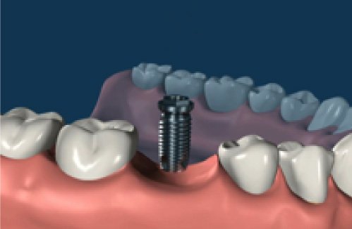 Dental Implant Procedure