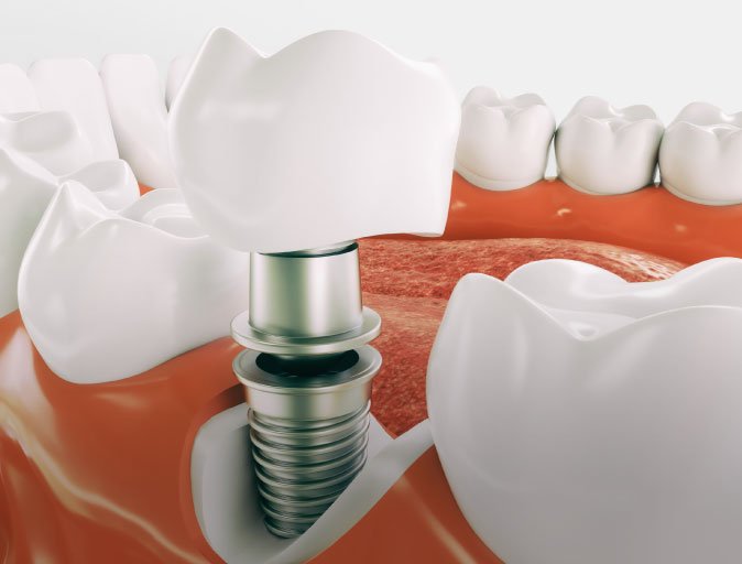 Snoqualmie Dental Implants